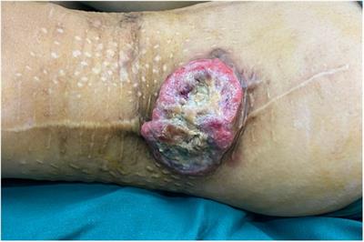 Undifferentiated pleomorphic sarcoma of the lateral thigh with KRAS/NF1 co-mutation recurred after repetitive surgical resection: A case report and review of the literature